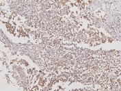 IHC staining of FFPE human glioma with ATP5MC1/2/3 antibody. HIER: boil tissue sections in pH6, 10mM citrate buffer, for 20 min and allow to cool before testing.