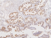 IHC staining of FFPE human ovarian cancer with ATP5MC1/2/3 antibody. HIER: boil tissue sections in pH6, 10mM citrate buffer, for 20 min and allow to cool before testing.