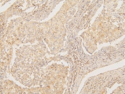 IHC staining of FFPE human lung cancer with ATP5MC1/2/3 antibody. HIER: boil tissue sections in pH6, 10mM citrate buffer, for 20 min and allow to cool before testing.