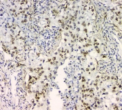 IHC staining of FFPE human lung cancer with BCL9L antibody. HIER: boil tissue sections in pH6, 10mM citrate buffer, for 20 min and allow to cool before testing.