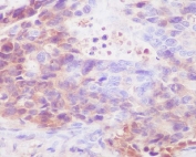 IHC staining of FFPE human stomach carcinoma with Human IgG4 antibody. HIER: boil tissue sections in pH6, 10mM citrate buffer, for 10-20 min and allow to cool before testing.