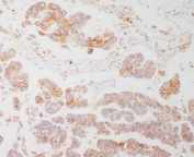 IHC staining of FFPE human lung tissue with HLA-DR antibody. HIER: boil tissue sections in pH8 EDTA for 20 min and allow to cool before testing.