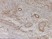 IHC staining of FFPE human testis cancer with EHD1 antibody. HIER: boil tissue sections in pH6, 10mM citrate buffer, for 10-20 min and allow to cool before testing.