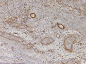 IHC staining of FFPE human testis cancer with EHD1 antibody. HIER: boil tissue sections in pH6, 10mM citrate buffer, for 10-20 min and allow to cool before testing.