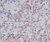 IHC staining of FFPE human liver cancer tissue with Fibronectin antibody. HIER: boil tissue sections in pH8 EDTA for 20 min and allow to cool before testing.
