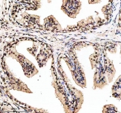 IHC staining of FFPE human prostatic hyperplasia tissue with phospho-ER alpha antibody. HIER: boil tissue sections in pH8 EDTA for 20 min and allow to cool before testing.