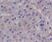 IHC staining of FFPE human hepatocellular carcinoma with MMP1 antibody. HIER: boil tissue sections in pH6, 10mM citrate buffer, for 10-20 min and allow to cool before testing.