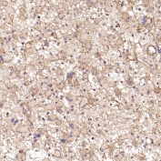 IHC staining of FFPE human astrocytoma tissue with MMP1 antibody. HIER: boil tissue sections in pH6, 10mM citrate buffer, for 10-20 min and allow to cool before testing.