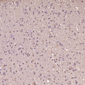 IHC staining of FFPE human glioblastoma tissue with S100 beta antibody. HIER: boil tissue sections in pH6, 10mM citrate buffer, for 10-20 min and allow to cool before testing.