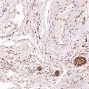 IHC staining of FFPE human testis cancer tissue with S100 beta antibody. HIER: boil tissue sections in pH6, 10mM citrate buffer, for 10-20 min and allow to cool before testing.
