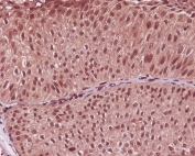 IHC staining of FFPE human bladder cancer with GAPDH antibody. HIER: boil tissue sections in pH6, 10mM citrate buffer, for 10-20 min and allow to cool before testing.