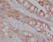 IHC staining of FFPE human colon tissue with CD8A antibody. HIER: boil tissue sections in pH6, 10mM citrate buffer, for 10-20 min and allow to cool before testing.
