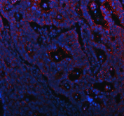 Immunofluorescent staining of FFPE human colon cancer tissue with MUC13 antibody (red) and DAPI nuclear stain (blue). HIER: steam section in pH8 EDTA buffer for 20 min.