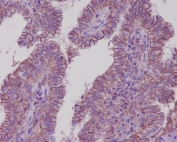 IHC staining of FFPE human thyroid carcinoma with ATP1A1 antibody. HIER: boil tissue sections in pH6, 10mM citrate buffer, for 10-20 min and allow to cool before testing.