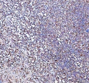IHC staining of FFPE human intestinal diffuse large B-cell lymphoma tissue with PPA2 antibody. HIER: boil tissue sections in pH8 EDTA for 20 min and allow to cool before testing.