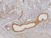 IHC staining of FFPE human breast cancer with RAB3GAP2 antibody. HIER: boil tissue sections in pH6, 10mM citrate buffer, for 20 min and allow to cool before testing.