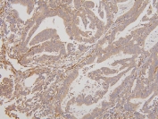 IHC staining of FFPE human rectal cancer with RAB3GAP2 antibody. HIER: boil tissue sections in pH6, 10mM citrate buffer, for 20 min and allow to cool before testing.
