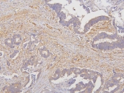 IHC staining of FFPE human colon cancer with RAB3GAP2 antibody. HIER: boil tissue sections in pH6, 10mM citrate buffer, for 20 min and allow to cool before testing.
