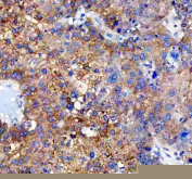 Immunohistochemical staining of FFPE human liver cancer tissue with Cytochrome P450 2E1 antibody, HRP-secondary and DAB substrate. HIER: boil tissue sections in pH8 EDTA for 20 min and allow to cool before testing.