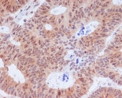 IHC staining of FFPE human colon cancer with phospho-EIF2S1 antibody (pS51). HIER: boil tissue sections in pH6, 10mM citrate buffer, for 10-20 min and allow to cool before testing.