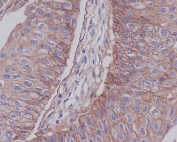 IHC staining of FFPE human bladder carcinoma with ITGB1 antibody. HIER: boil tissue sections in pH6, 10mM citrate buffer, for 10-20 min and allow to cool before testing.