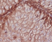 IHC staining of FFPE human breast cancer with CD29 antibody. HIER: boil tissue sections in pH6, 10mM citrate buffer, for 10-20 min and allow to cool before testing.