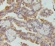 IHC staining of FFPE human renal cancer with SGLT2 antibody. HIER: boil tissue sections in pH6, 10mM citrate buffer, for 20 min and allow to cool before testing.