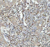 IHC staining of FFPE human breast cancer tissue with GPX1 antibody. HIER: boil tissue sections in pH8 EDTA for 20 min and allow to cool before testing.