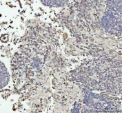 IHC staining of FFPE human lung squamous cell carcinoma tissue with GPX1 antibody. HIER: boil tissue sections in pH8 EDTA for 20 min and allow to cool before testing.