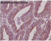 IHC staining of FFPE human uterine cancer with Beta Tubulin antibody. HIER: boil tissue sections in pH6, 10mM citrate buffer, for 10-20 min and allow to cool before testing.