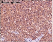 IHC staining of FFPE human glioma with Beta Tubulin antibody. HIER: boil tissue sections in pH6, 10mM citrate buffer, for 10-20 min and allow to cool before testing.