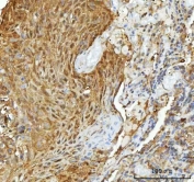 IHC staining of FFPE human lung cancer tissue with HSP90 alpha/beta antibody. HIER: boil tissue sections in pH8 EDTA for 20 min and allow to cool before testing.