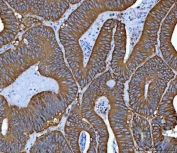 IHC staining of FFPE human colorectal adenocarcinoma tissue with HSP90 alpha/beta antibody. HIER: boil tissue sections in pH8 EDTA for 20 min and allow to cool before testing.