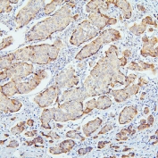 IHC staining of FFPE human breast cancer with SMARCAD1 antibody. HIER: boil tissue sections in pH6, 10mM citrate buffer, for 20 min and allow to cool before testing.