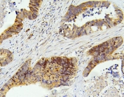 IHC staining of FFPE human colon cancer with SMARCAD1 antibody. HIER: boil tissue sections in pH6, 10mM citrate buffer, for 20 min and allow to cool before testing.