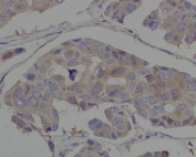 IHC staining of FFPE human breast cancer with HSP90AA1 antibody. HIER: boil tissue sections in pH6, 10mM citrate buffer, for 10-20 min and allow to cool before testing.