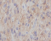IHC staining of FFPE human glioma with p75NTR antibody. HIER: boil tissue sections in pH6, 10mM citrate buffer, for 10-20 min and allow to cool before testing.