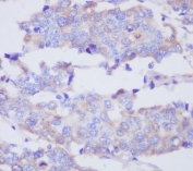IHC staining of FFPE human breast cancer with MMP2 antibody. HIER: boil tissue sections in pH6, 10mM citrate buffer, for 10-20 min and allow to cool before testing.