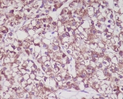 IHC staining of FFPE human liver cancer with MMP3 antibody. HIER: boil tissue sections in pH6, 10mM citrate buffer, for 10-20 min and allow to cool before testing.