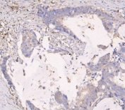 IHC staining of FFPE human intestinal cancer with APOBEC3G antibody. HIER: boil tissue sections in pH8 EDTA for 20 min and allow to cool before testing.