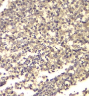 IHC staining of FFPE human testis cancer with ATP Citrate Lyase antibody. HIER: boil tissue sections in pH8 EDTA for 20 min and allow to cool before testing.