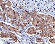 IHC staining of FFPE human breast cancer with CDC42 antibody. HIER:HIER: boil tissue sections in pH8 EDTA for 20 min and allow to cool before testing.