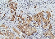 IHC staining of FFPE human breast cancer with CDC42 antibody. HIER: boil tissue sections in pH6, 10mM citrate buffer, for 20 min and allow to cool before testing.