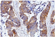 IHC staining of FFPE human colon cancer with CDC42 antibody. HIER: boil tissue sections in pH8 EDTA for 20 min and allow to cool before testing.