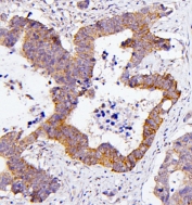 IHC staining of FFPE human colon cancer with CDC42 antibody. HIER: boil tissue sections in pH6, 10mM citrate buffer, for 20 min and allow to cool before testing.