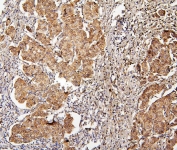 IHC staining of FFPE human breast cancer with Ch-TOG antibody. HIER: boil tissue sections in pH6, 10mM citrate buffer, for 20 min and allow to cool before testing.