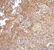 IHC staining of FFPE human lung cancer with Ch-TOG antibody. HIER: boil tissue sections in pH6, 10mM citrate buffer, for 20 min and allow to cool before testing.