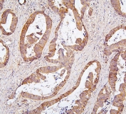 IHC staining of FFPE human intestinal cancer with Ch-TOG antibody. HIER: boil tissue sections in pH6, 10mM citrate buffer, for 20 min and allow to cool before testing.
