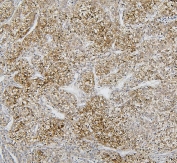IHC staining of FFPE human liver cancer with CYP2C19 antibody. HIER: boil tissue sections in pH8 EDTA for 20 min and allow to cool before testing.