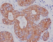 IHC staining of FFPE human breast carcinoma with Cytokeratin 7 antibody. HIER: boil tissue sections in pH6, 10mM citrate buffer, for 10-20 min and allow to cool before testing.